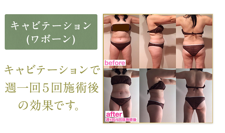 キャビテーション