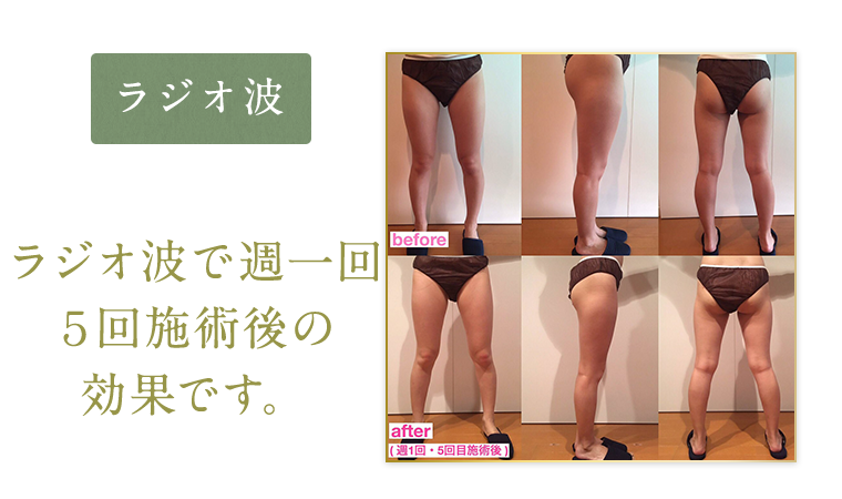ラジオ派
